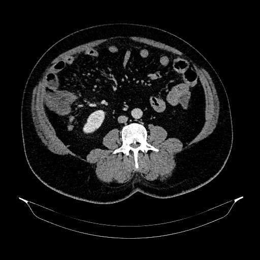 Acute appendicitis (Radiopaedia 79950-93224 Axial C+ portal venous phase 58).jpg