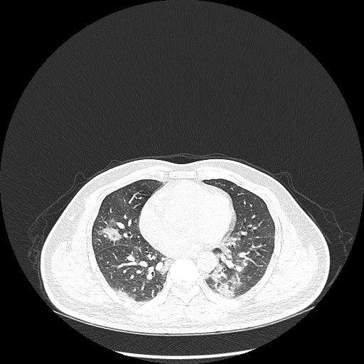 Acute appendicitis and COVID 19 pneumonia (Radiopaedia 76604-88380 Axial lung window 32).jpg