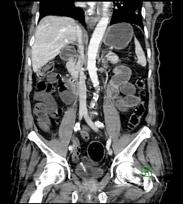 Acute arterial mesenteric ischemia (Radiopaedia 78238-90828 Coronal C+ portal venous phase 53).jpg