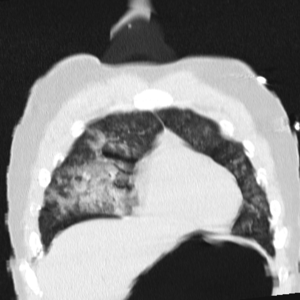 Acute aspiration pneumonitis (Radiopaedia 33605-34703 Coronal lung window 23).jpg