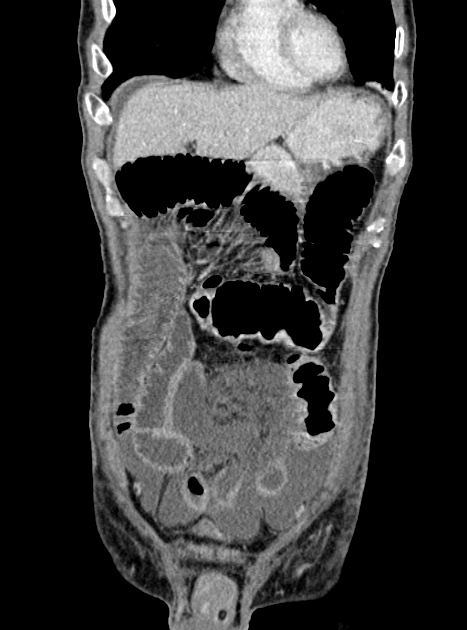 Acute bowel ischemia (Radiopaedia 87695-104114 Coronal C+ portal venous phase 118).jpg