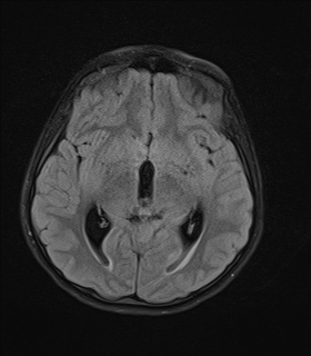 File:Acute cerebellar ataxia (Radiopaedia 61487-69446 Axial FLAIR 10).jpg