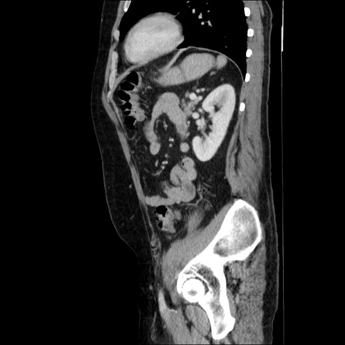 Acute cholecystitis and incidental left sided IVC (Radiopaedia 49352-54459 Sagittal C+ portal venous phase 31).jpg