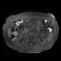 Acute cholecystitis complicated by pylephlebitis (Radiopaedia 65782-74915 Axial T1 fat sat 76).jpg