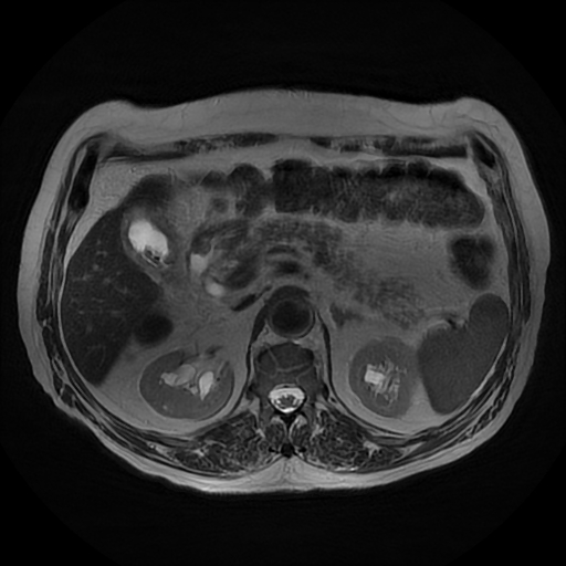 File:Acute cholecystitis complicated by pylephlebitis (Radiopaedia 65782-74915 Axial T2 19).jpg