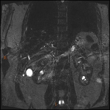 File:Acute cholecystitis with gallbladder neck calculus (Radiopaedia 42795-45971 Coronal Turbo spin echo 1).jpg