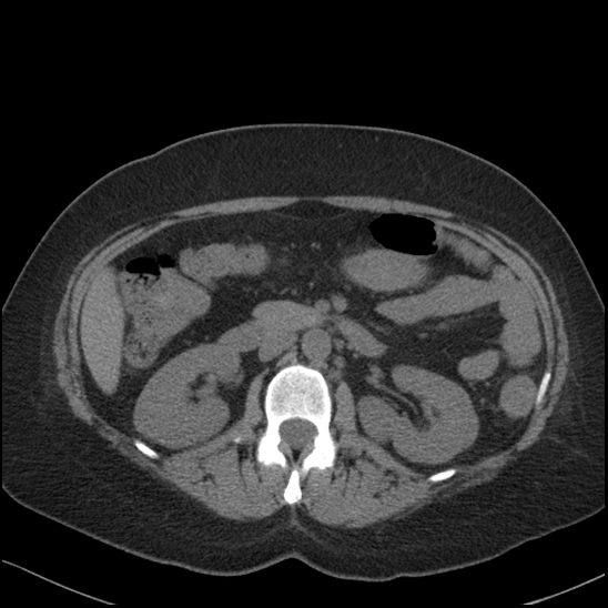 Acute colonic hemorrhage in ulcerative colitis (Radiopaedia 77415-89538 Axial non-contrast 54).jpg