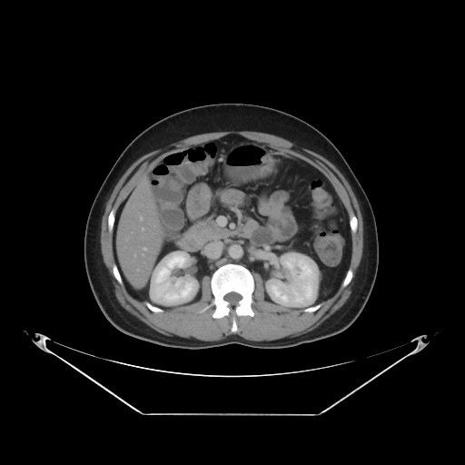 File:Acute complicated calculous cholecystitis (Radiopaedia 55202-61587 Axial C+ delayed 42).jpg