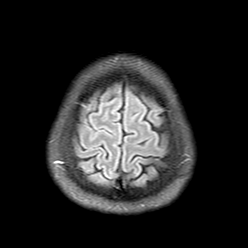 File:Acute disseminated encephalomyelitis (ADEM)- Anti-NMDA receptor encephalitis (Radiopaedia 54920-61198 Axial FLAIR post-GAD 22).png