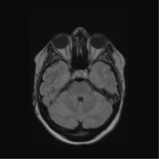 Acute disseminated encephalomyelitis (ADEM) (Radiopaedia 38073-40065 Axial FLAIR 17).png