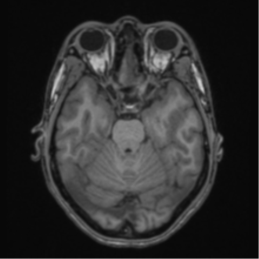 Acute disseminated encephalomyelitis (ADEM) (Radiopaedia 65319-74349 Axial T1 19).png