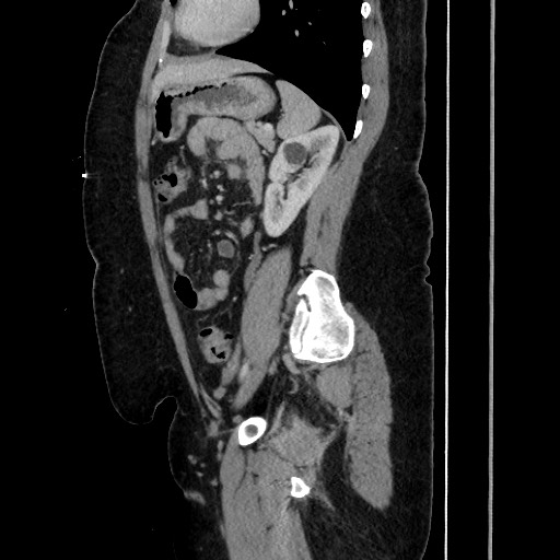 Acute diverticulitis - transverse colon (Radiopaedia 87063-103327 Sagittal C+ portal venous phase 151).jpg