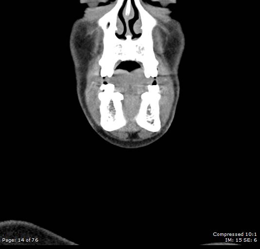 Acute epiglottitis (Radiopaedia 54375-60590 Coronal C+ arterial phase 14).jpg