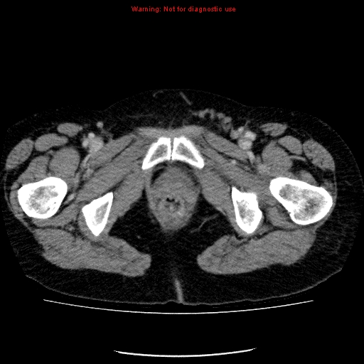 Acute gangrenous cholecystitis (Radiopaedia 10123-10661 Axial C+ portal venous phase 104).jpg