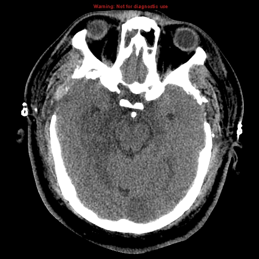 Acute hemorrhagic leukoencephalitis (Radiopaedia 14076-43697 Axial non-contrast 17).jpg