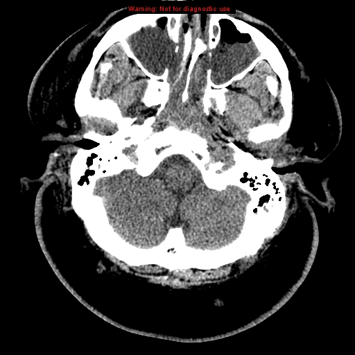 Acute hemorrhagic leukoencephalitis (Radiopaedia 14076-43697 Axial non-contrast 5).jpg