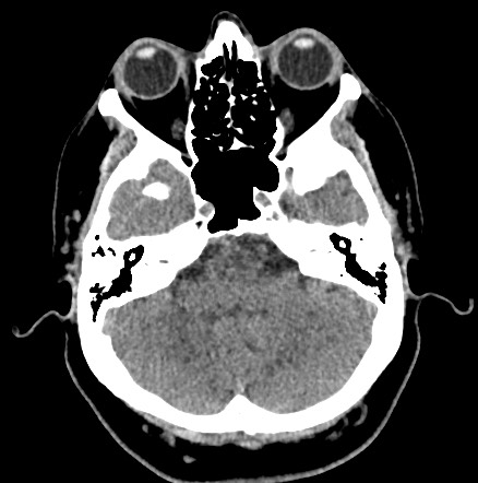 Acute internal carotid artery dissection (Radiopaedia 53541-59558 Axial non-contrast 14).jpg