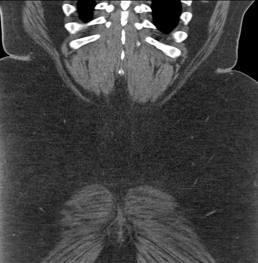 Acute mesenteric venous ischemia (Radiopaedia 46041-50383 Coronal C+ portal venous phase 90).jpg