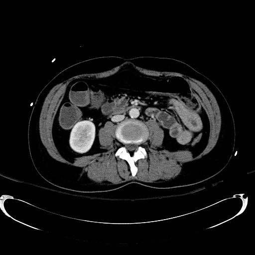 Acute myocardial infarction in CT (Radiopaedia 39947-42415 Axial C+ portal venous phase 68).jpg