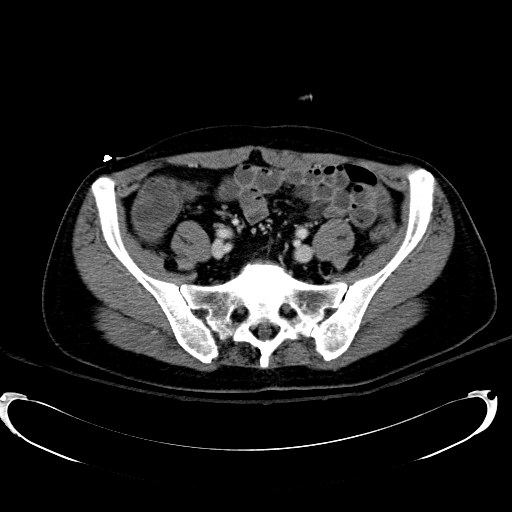 Acute myocardial infarction in CT (Radiopaedia 39947-42415 Axial C+ portal venous phase 96).jpg