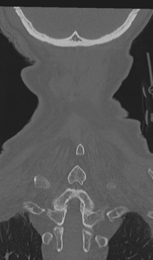 Acute on chronic subdural hematoma and thoracic vertebral injury in a multitrauma patient (Radiopaedia 31698-32619 Coronal bone window 60).jpg