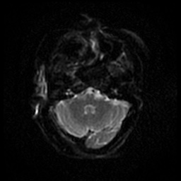 Acute otitis externa (Radiopaedia 57296-64236 Axial DWI 36).jpg