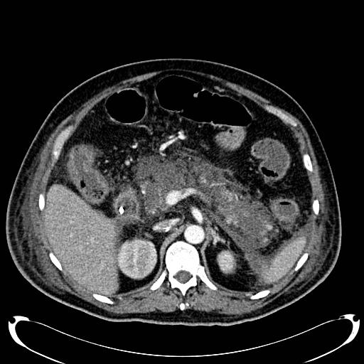 Acute pancreatic necrosis (Radiopaedia 13560-18500 Axial C+ portal venous phase 54).jpg
