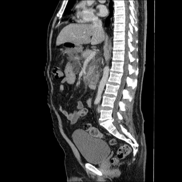 Acute pancreatitis (Radiopaedia 26663-26813 Sagittal C+ portal venous phase 37).jpg