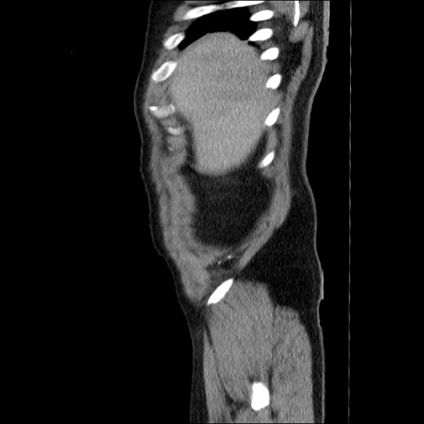 Acute pancreatitis (Radiopaedia 26663-26813 Sagittal C+ portal venous phase 8).jpg