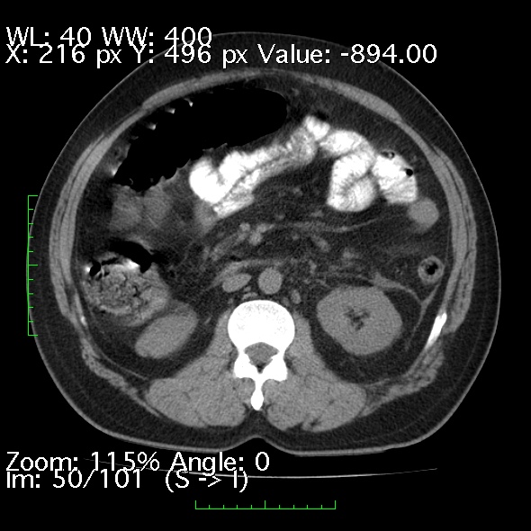 Acute pancreatitis (Radiopaedia 34043-35276 Axial non-contrast 50).jpg