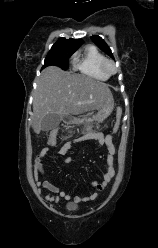Acute pancreatitis (Radiopaedia 80007-93285 Coronal C+ portal venous phase 20).jpg