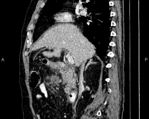 Acute pancreatitis (Radiopaedia 85146-100701 Sagittal C+ portal venous phase 35).jpg