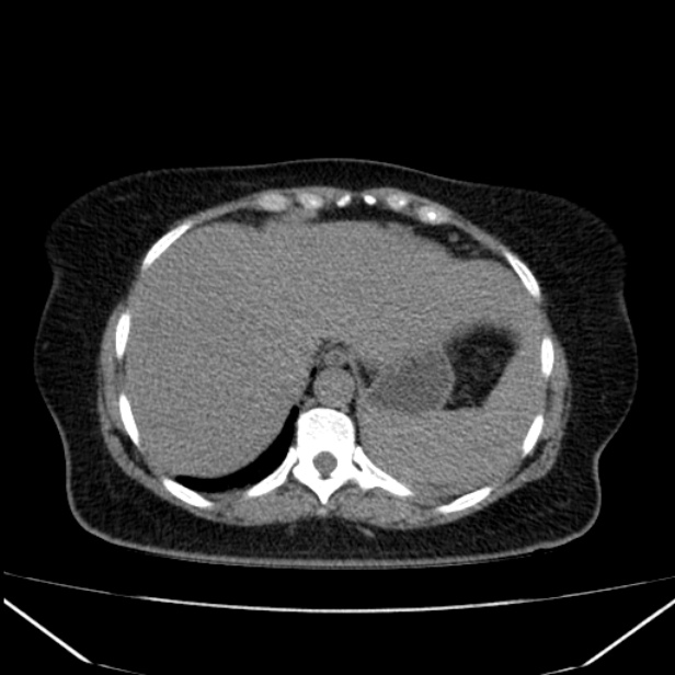 Acute pancreatitis - Balthazar C (Radiopaedia 26569-26714 Axial non-contrast 19).jpg