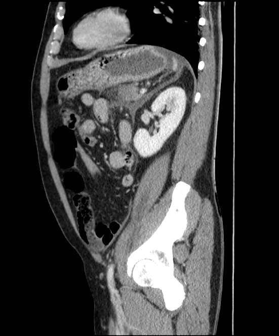 Acute pancreatitis - Balthazar E (Radiopaedia 23080-23110 Sagittal C+ portal venous phase 71).jpg