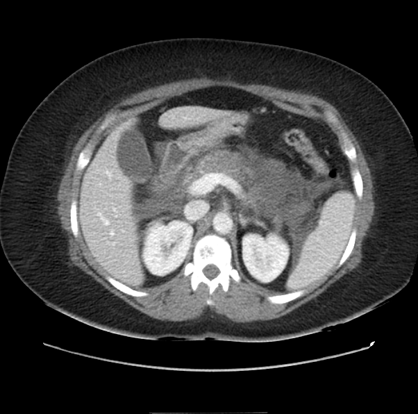 Acute pancreatitis - Balthazar E (Radiopaedia 29016-29377 Axial C+ portal venous phase 22).png