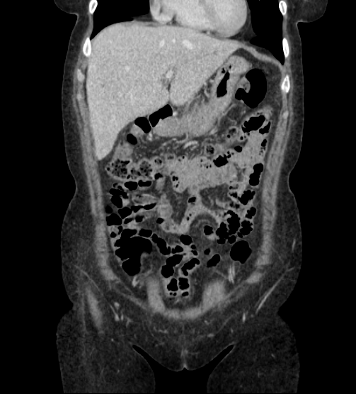 Acute pancreatitis - Balthazar E - post ERCP (Radiopaedia 27562-27772 Coronal C+ portal venous phase 21).png