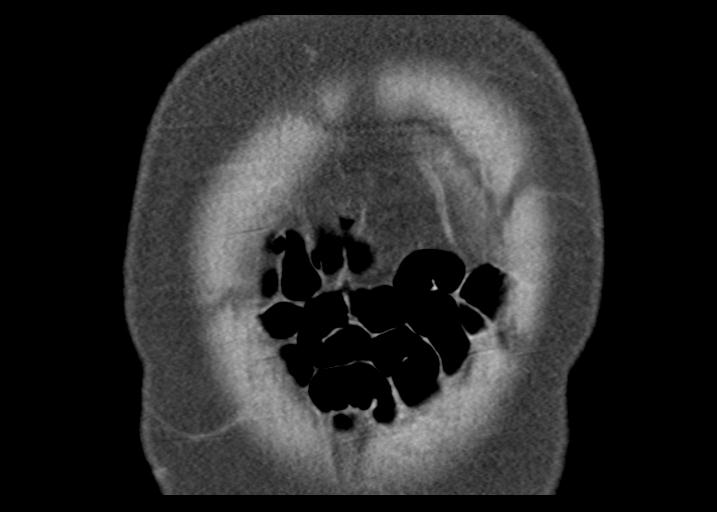 Acute pancreatitis and walled-off necrosis (Radiopaedia 29888-30403 Coronal C+ portal venous phase 8).jpg