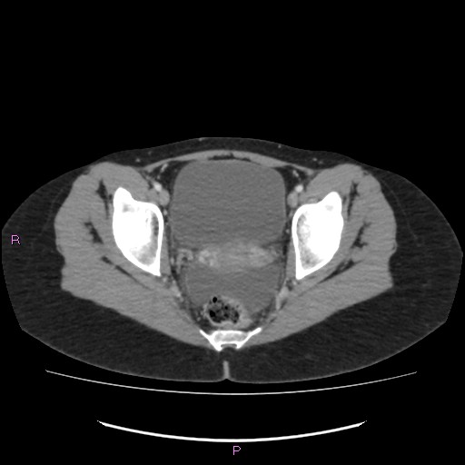Acute pancreatitis secondary to stone at minor papilla and pancreatic divisum (Radiopaedia 76570-88333 Axial C+ portal venous phase 73).jpg