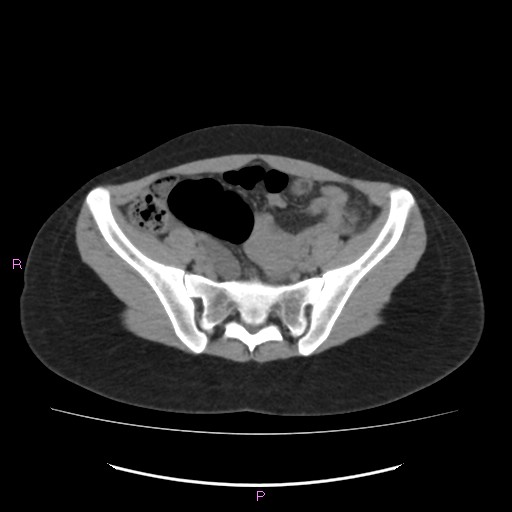 Acute pancreatitis secondary to stone at minor papilla and pancreatic divisum (Radiopaedia 76570-88333 Axial non-contrast 58).jpg