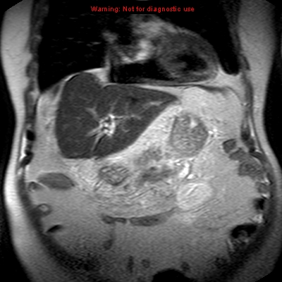 File:Acute pancreatitis with incidental pancreatic lipoma (Radiopaedia 10190-10732 Coronal T2 9).jpg
