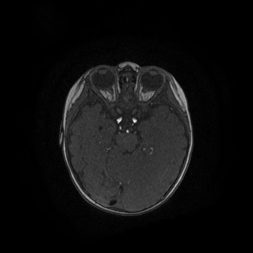Acute phase of hemiconvulsion-hemiplegia epilepsy syndrome (Radiopaedia 29309-29745 Axial TOF angiography 89).jpg