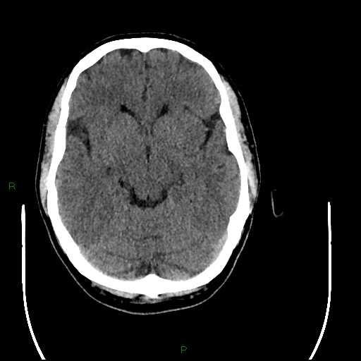 Acute posterior cerebral artery territory infarct (Radiopaedia 79329-92393 Axial non-contrast 44).jpg
