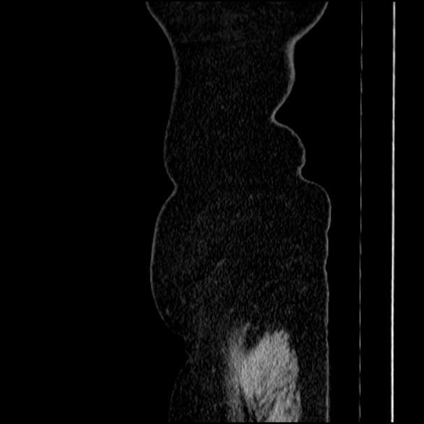 Acute pyelonephritis (Radiopaedia 33397-34434 Sagittal renal parenchymal phase 88).jpg
