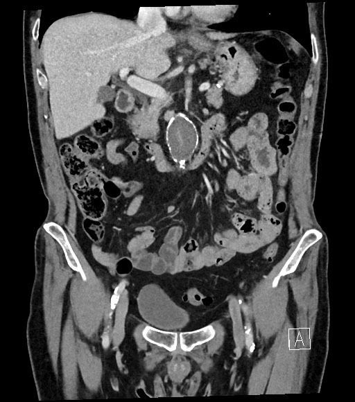 Acute renal infarction (Radiopaedia 59375-66736 Coronal C+ portal venous phase 27).jpg