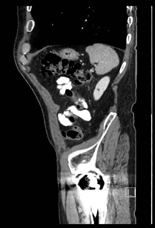 Acute renal infarction - rim capsular enhancement (Radiopaedia 59833-67270 Sagittal C+ portal venous phase 19).jpg