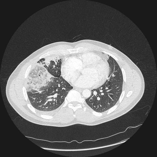 File:Acute segmental pulmonary emboli and pulmonary infarction (Radiopaedia 62264-70444 Axial lung window 121).jpg