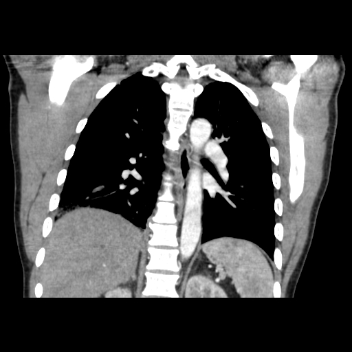 File:Acute segmental pulmonary emboli and pulmonary infarction (Radiopaedia 62264-70444 Coronal C+ CTPA 35).jpg