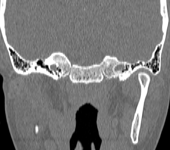 Acute sinusitis (Radiopaedia 40564-43158 Coronal bone window 53).jpg
