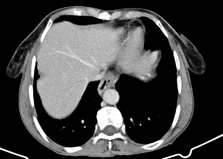 Acute small bowel (ileal) volvulus (Radiopaedia 71740-82139 Axial C+ portal venous phase 39).jpg