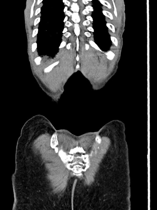Acute small bowel (ileal) volvulus (Radiopaedia 71740-82139 Coronal C+ portal venous phase 104).jpg